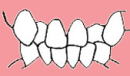 大阪　歯列矯正　かわさと歯科　矯正歯科　Ⅰ級叢生（乱杭歯、八重歯）　図解