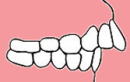 大阪　歯列矯正　かわさと歯科　矯正歯科　Ⅱ級（上顎前突・でっ歯）図解