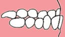 大阪　歯列矯正　かわさと歯科　矯正歯科　Ⅲ級（下顎前突・反対咬合・うけ口）図解