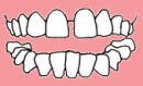 大阪　歯列矯正　かわさと歯科　矯正歯科　空隙歯列弓（すきっ歯）図解