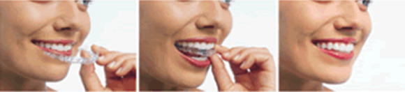 歯並び矯正歯科（歯列矯正）大阪 梅田 かわさと歯科 矯正歯科　インビザライン1