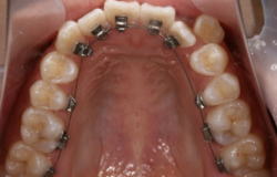 裏側矯正歯科2